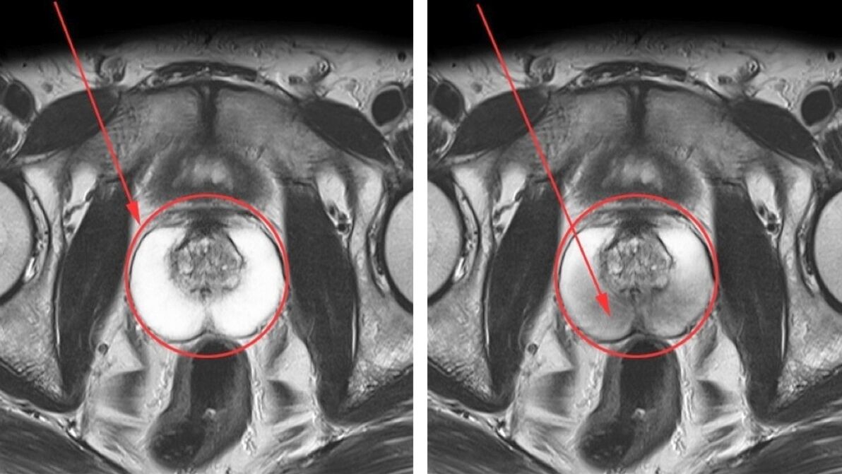 Ուլտրաձայնային հետազոտություն քրոնիկ պրոստատիտի համար՝ առողջ շագանակագեղձ (ձախ) և բորբոքված (աջ)