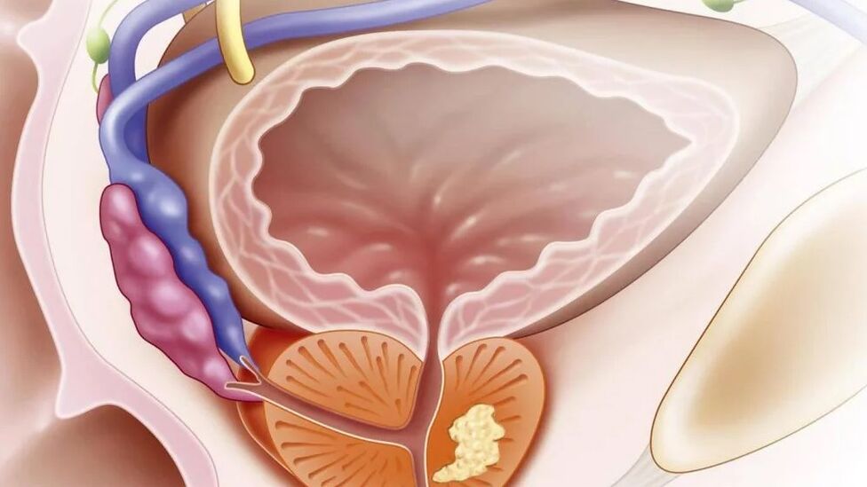 NeBacterial քրոնիկ պրոստատիտ